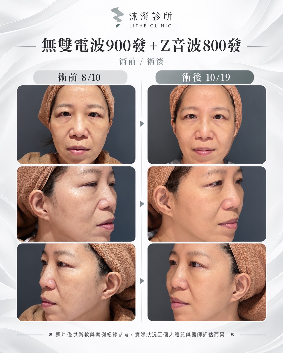 沐澄診所無雙電波 900 發搭配 Z 音波 800 發術前術後對照